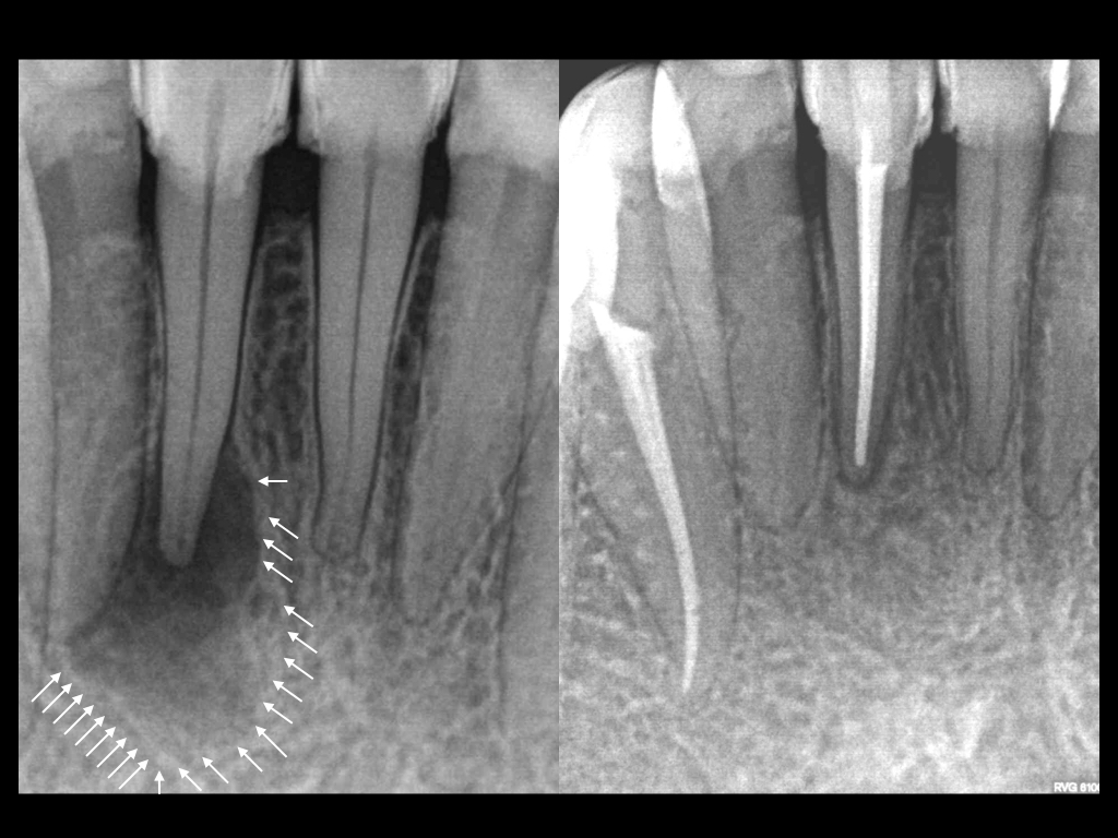 Эндодонтическое лечение каналов зубов 