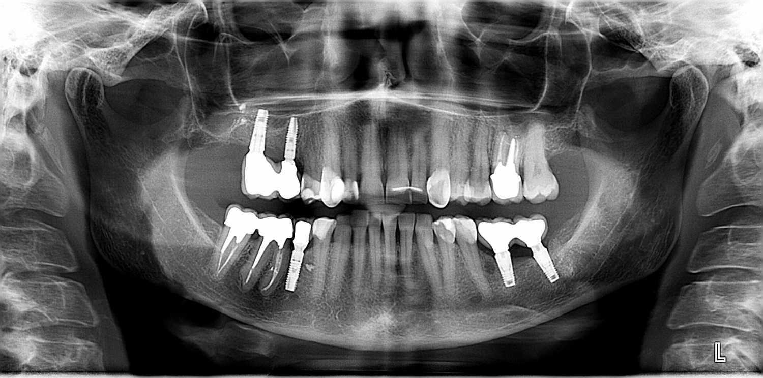 Возмещение отсутствующих и несостоятельных зубов боковой области имплантатами.